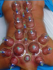 cupping